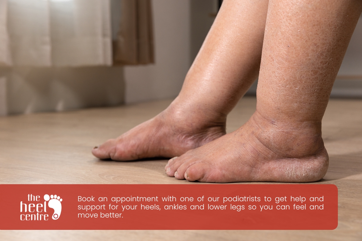 Diabetic Foot Care: Prevention And Management 2 Diabetic Foot Complication | The Heel Centre