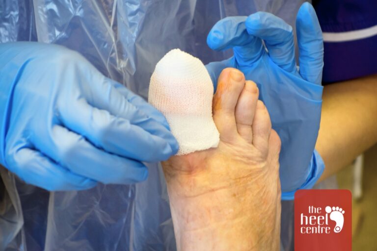 Frankston Toe Nail Care | The Heel Centre Frankston
